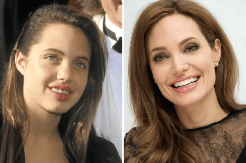 Exemple de transformation du sourire grâce à l’orthodontie à Bni Yakhlef