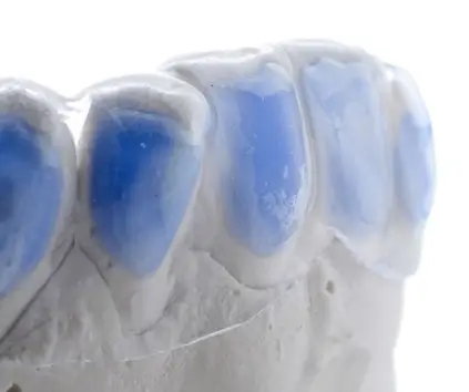 Gouttières sur mesure avec gel de blanchiment dentaire utilisé à domicile, prescription du cabinet dentaire Signature à Ben Yakhlef