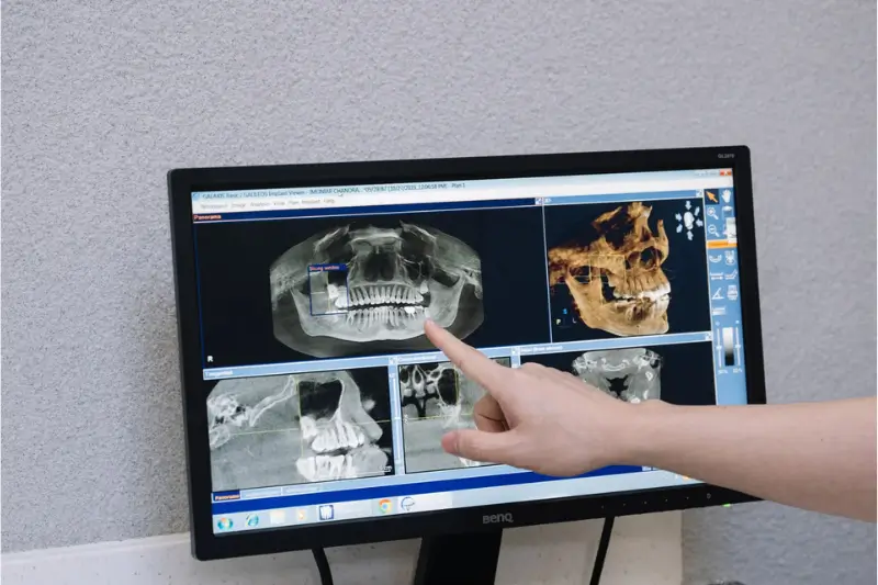 Analyse d’une radiographie panoramique avant extraction ou chirurgie dentaire à Bni Yakhlef